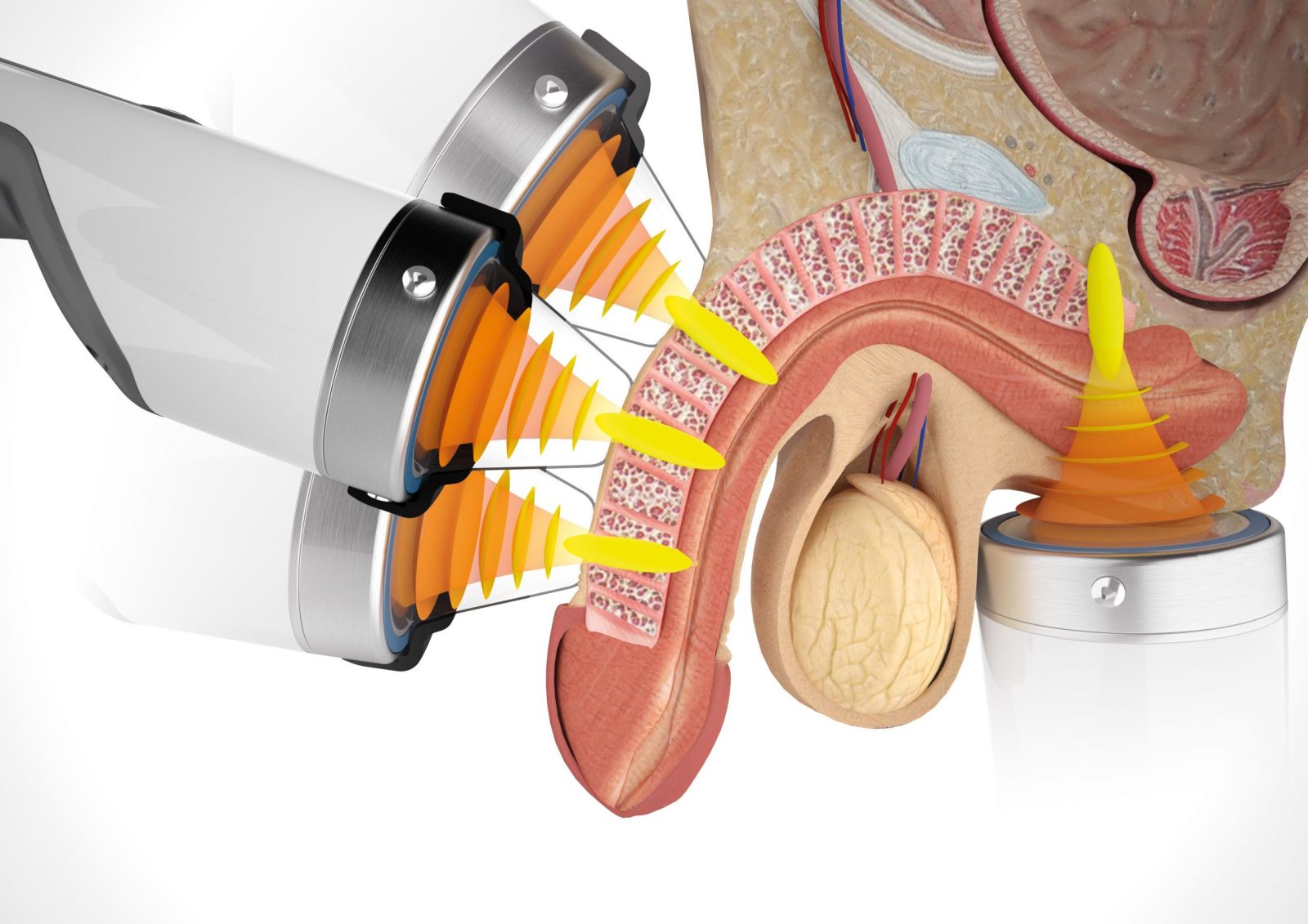 ESWT Shockwave Therapy
